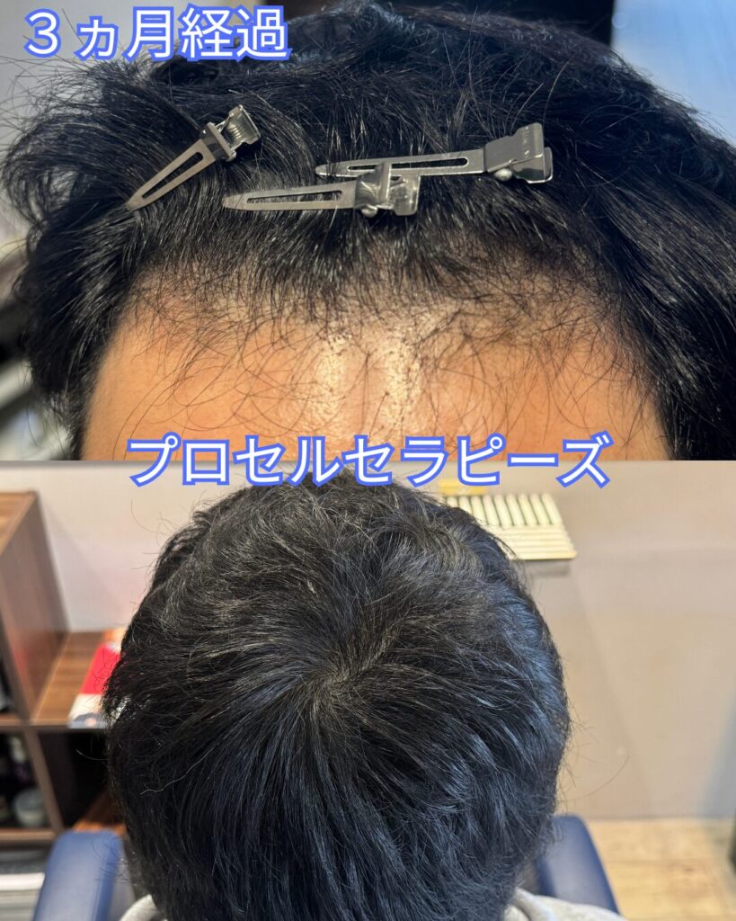 プロセル　3ヵ月経過