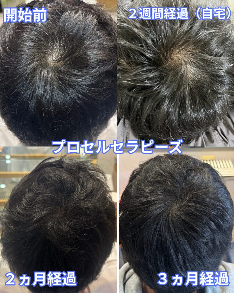 プロセル　つむじ　まとめ