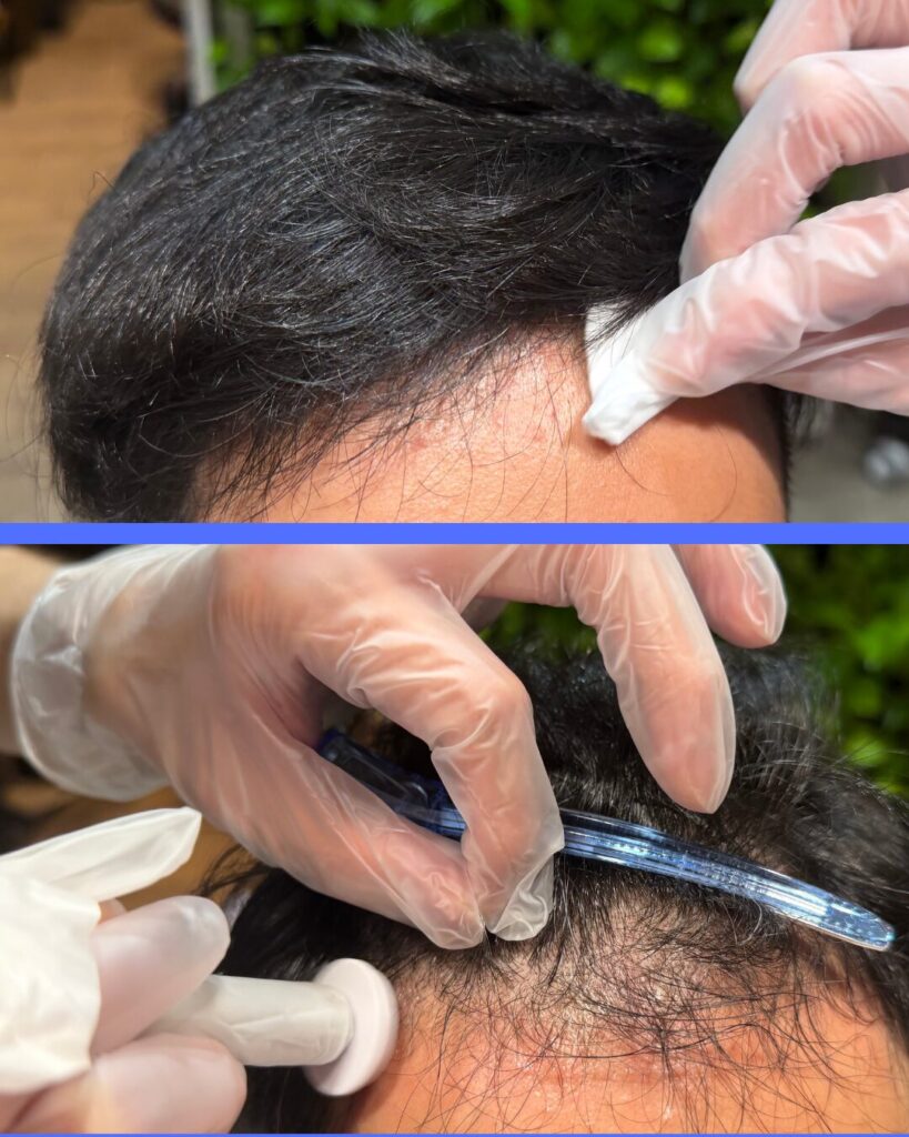 プロセル　施術中