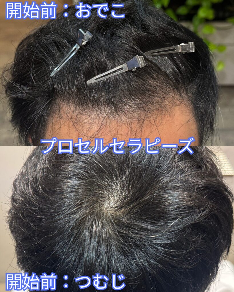 プロセル　0ヵ月