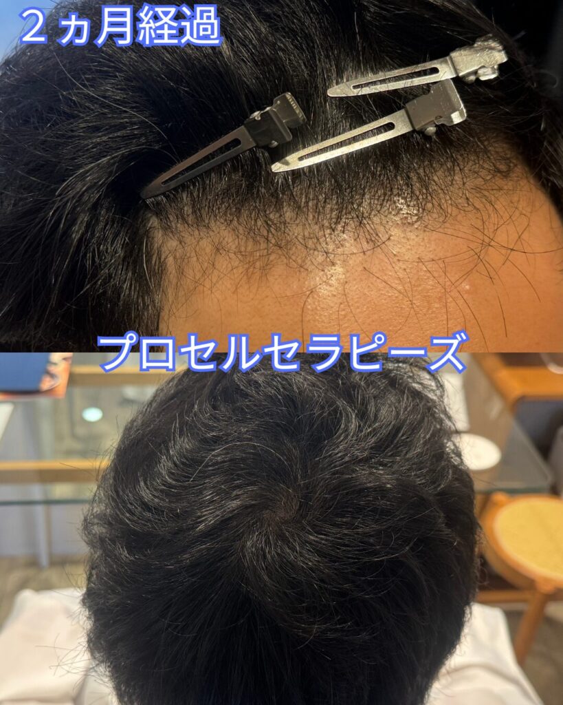 プロセル　2ヵ月経過