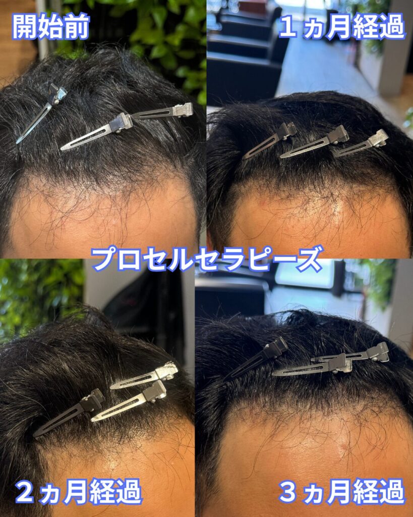 プロセル　おでこ　まとめ