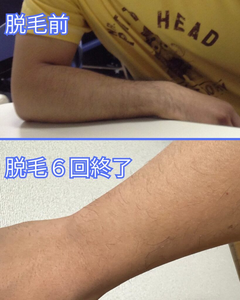 脱毛 腕