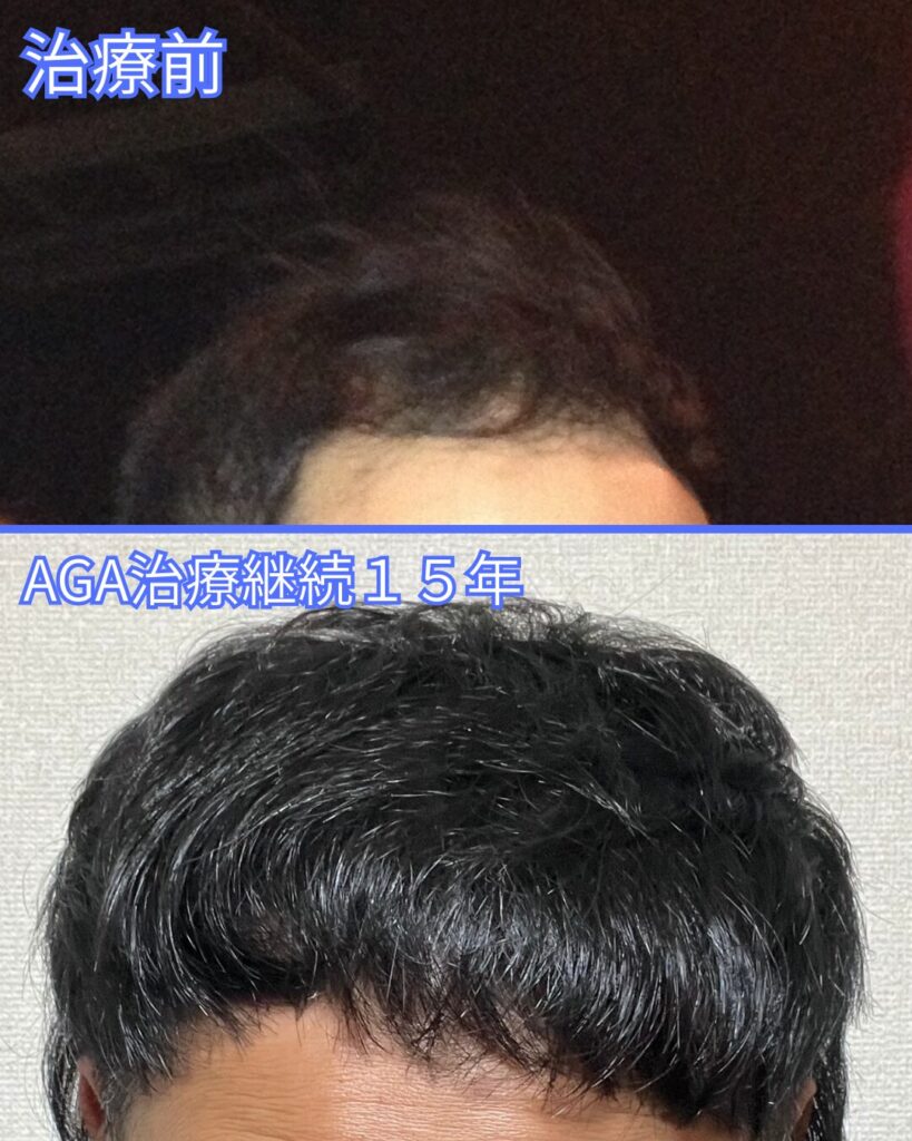 AGA治療　経過